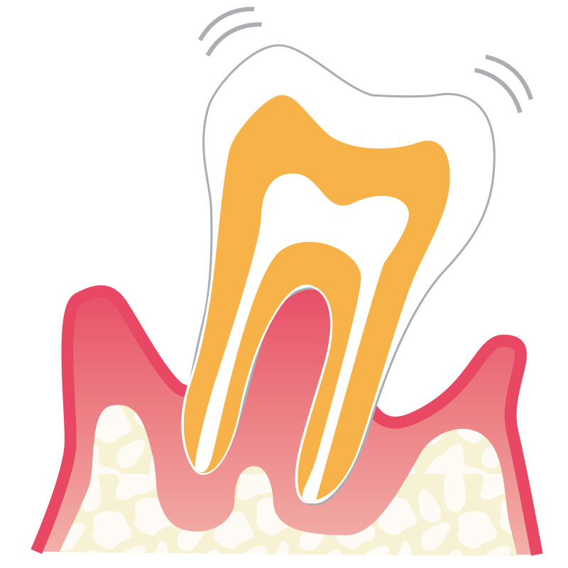 歯周炎（重度）の説明イラスト