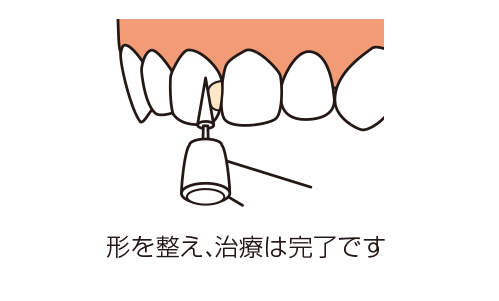歯の形を整えるイラスト