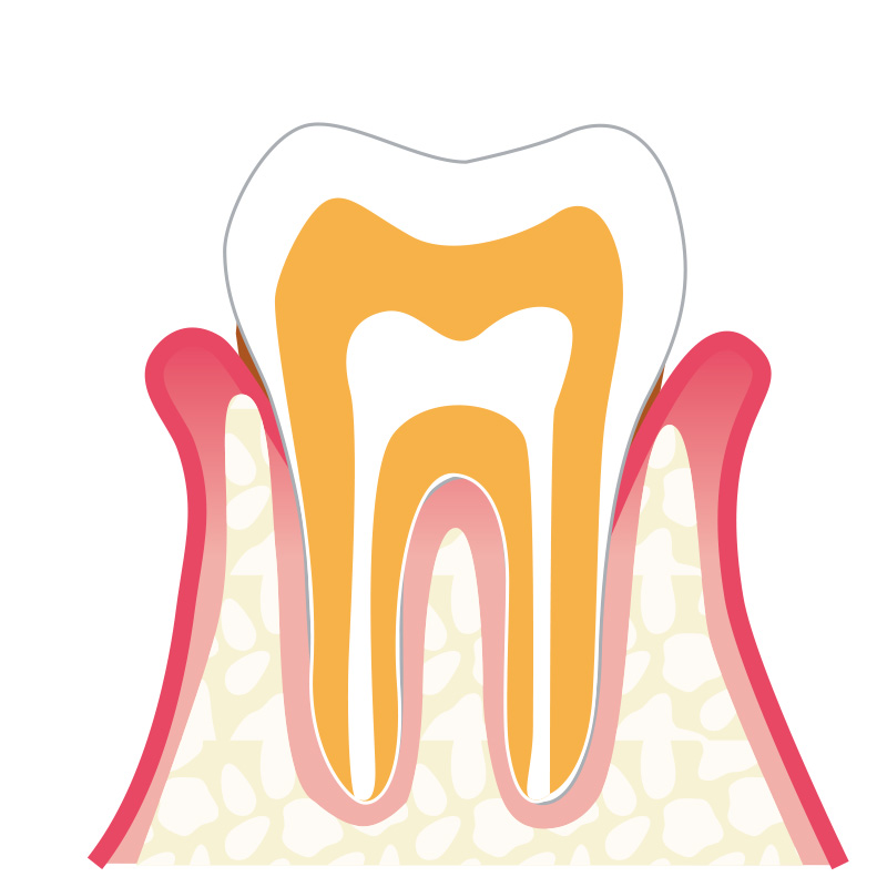 歯肉炎症状の説明イラスト