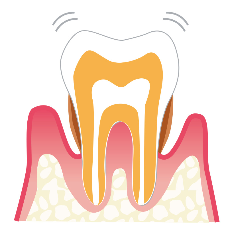 歯周炎（軽度）の説明イラスト
