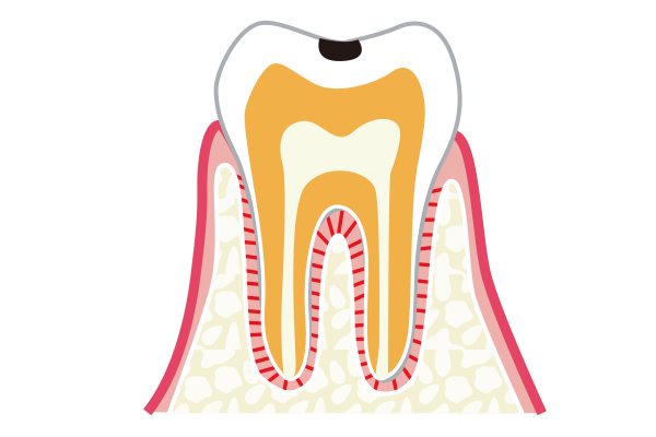 C1エナメル質に穴が空いた虫歯のイラスト