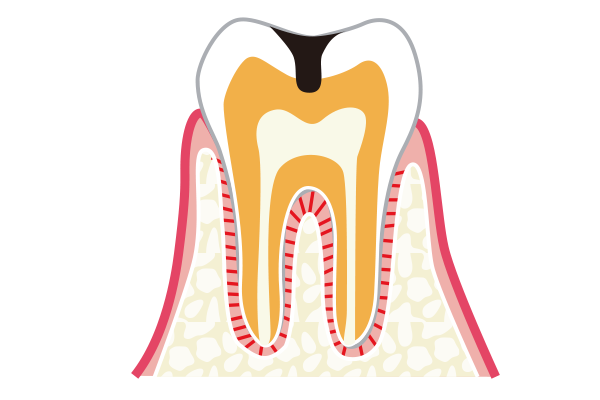 C2象牙質に達した虫歯のイラスト