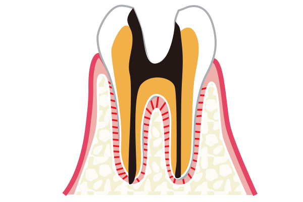C4神経が死んでしまい抜歯をしなくてはならない虫歯のイラスト