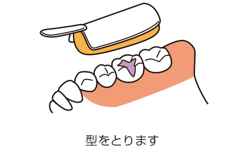 奥歯の型をとるイラスト