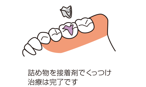 詰め物を接着剤でくっつけるイラスト