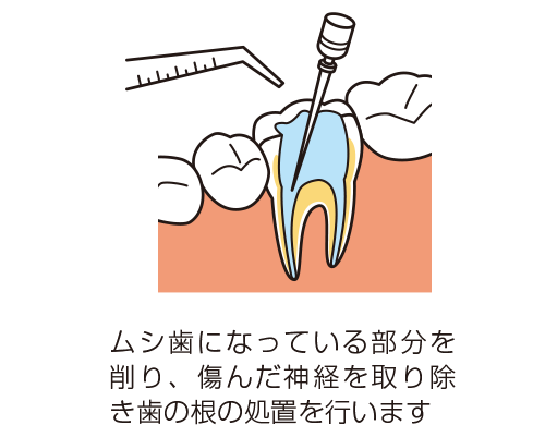 神経を取り除く処置のイラスト