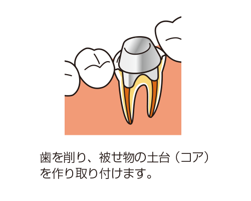 歯を削り土台を取り付けるイラスト