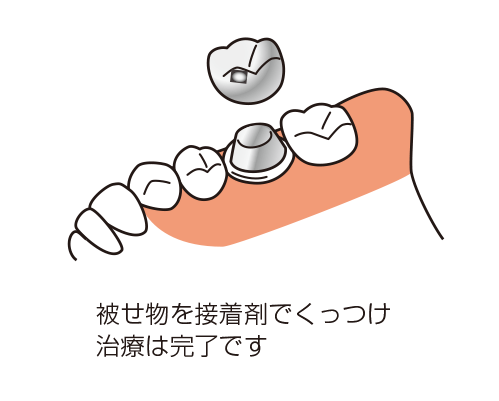 被せものを接着剤でくっつけるイラスト