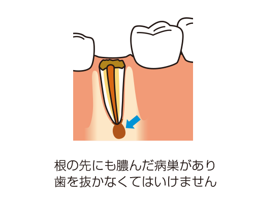 根の先端に膿んだ病巣があるイラスト